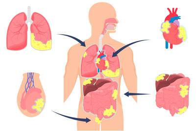 Malignant Pleural Mesothelioma 